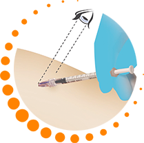 Inmunoterapia Intradérmica con alergoides (IDIT)
